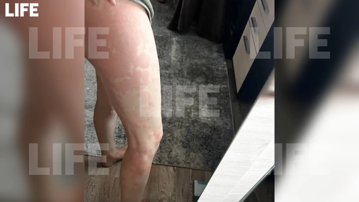 Красные пятна появились на теле у россиянки после того, как она уснула с никотиносодержащей пастилкой во рту. Фото © Life.ru