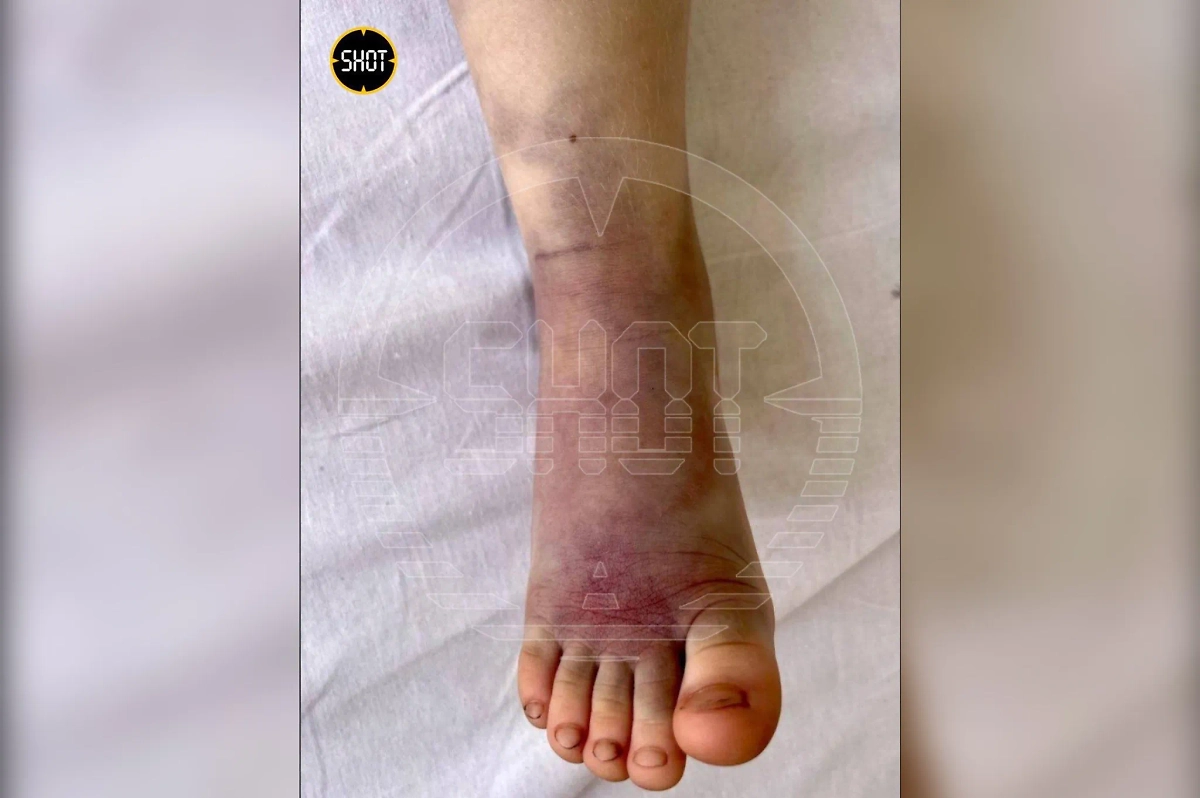 В Подмосковье гадюка укусила за ногу 4-летнего мальчика, гулявшего по дачному участку. Фото © SHOT