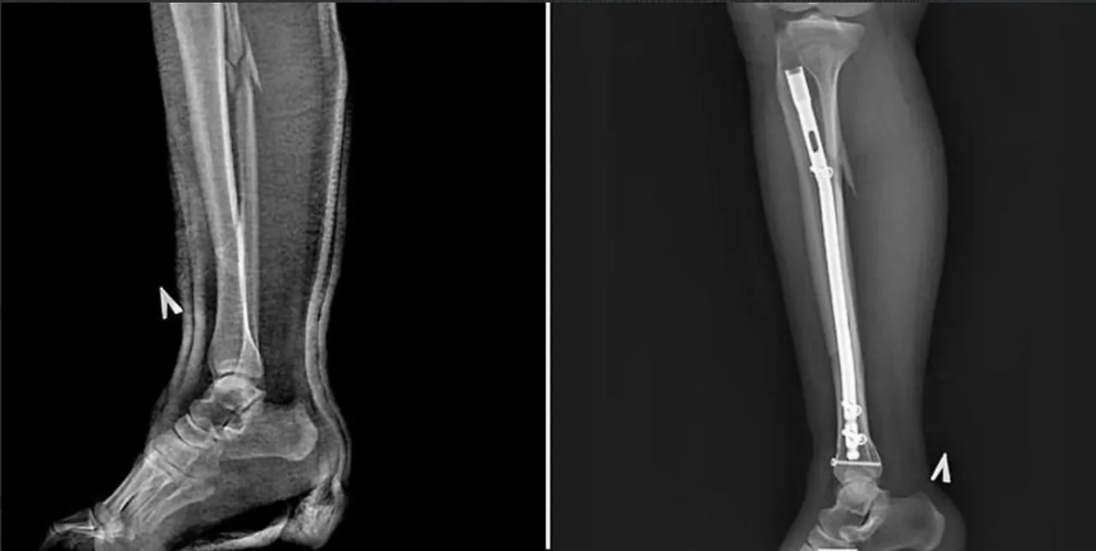 Перелом в трёх местах из-за каблука. Фото предоставлено Life.ru