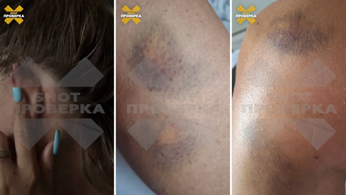 Гематомы на теле мастера маникюра и её клиентки после драки. Фото © SHOT ПРОВЕРКА