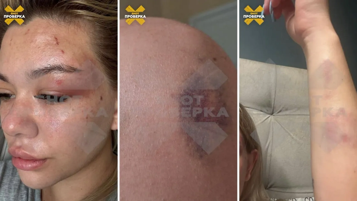 Травмы мастера маникюра и её клиентки после драки. Фото © SHOT ПРОВЕРКА