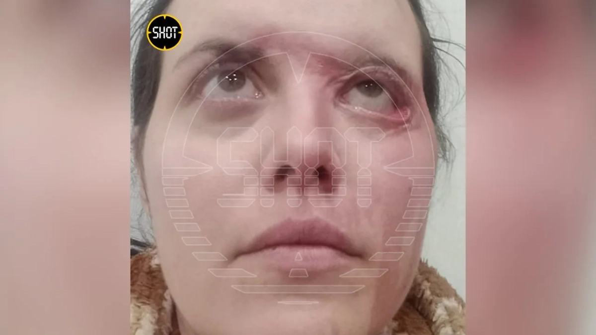 Жертва "кислотного маньяка" Анастасия Лобода. Фото © SHOT