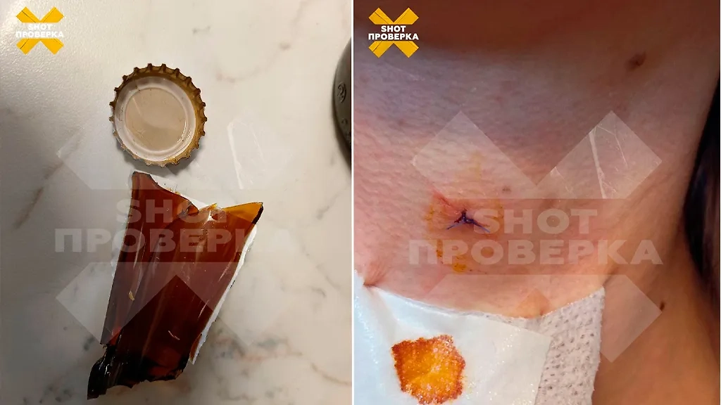 Один из осколков бутылки прилетел прямо в шею девушки. Фото © Telegram / "SHOT Проверка"