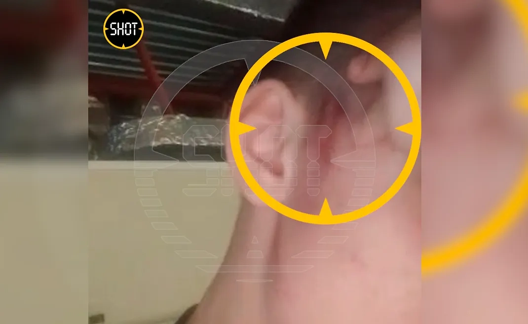 Гематомы у погибшего бойца ММА из Кирова. Фото © t.me / SHOT