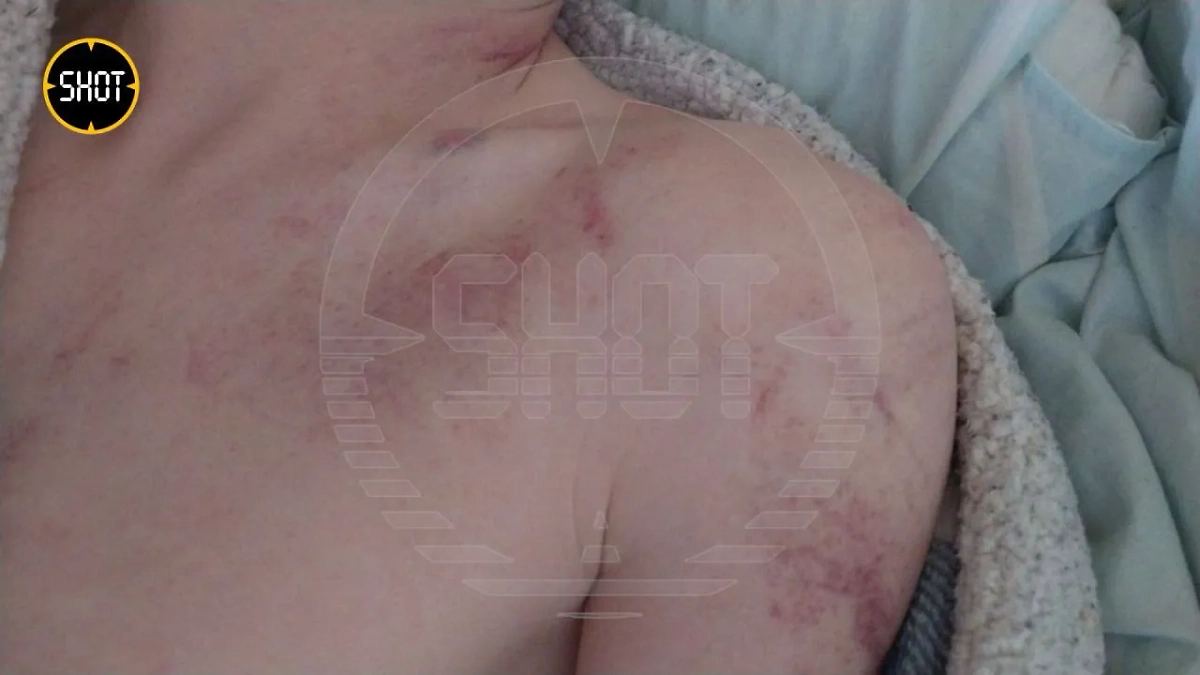 Пострадавший на квесте в Москве подросток. Фото © T.me / SHOT