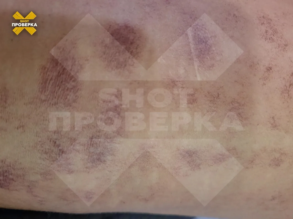 Девушка получила 40%  после лазерной эпиляции. Фото © SHOT ПРОВЕРКА