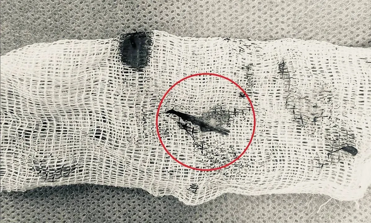 Спичка, которую достали из уха жителя Долгопрудного. Фото © Минздрав Московской области