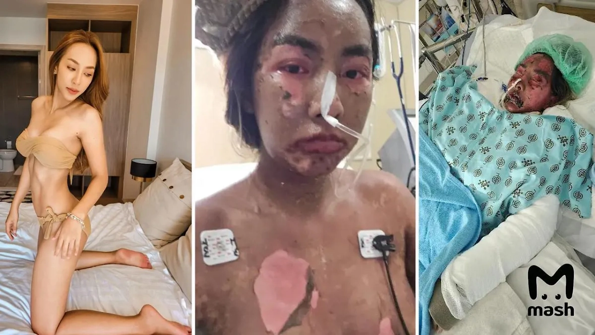 Сасинан Чуэнлосанг до и после курса антибиотиков. Фото © Telegram / Mash