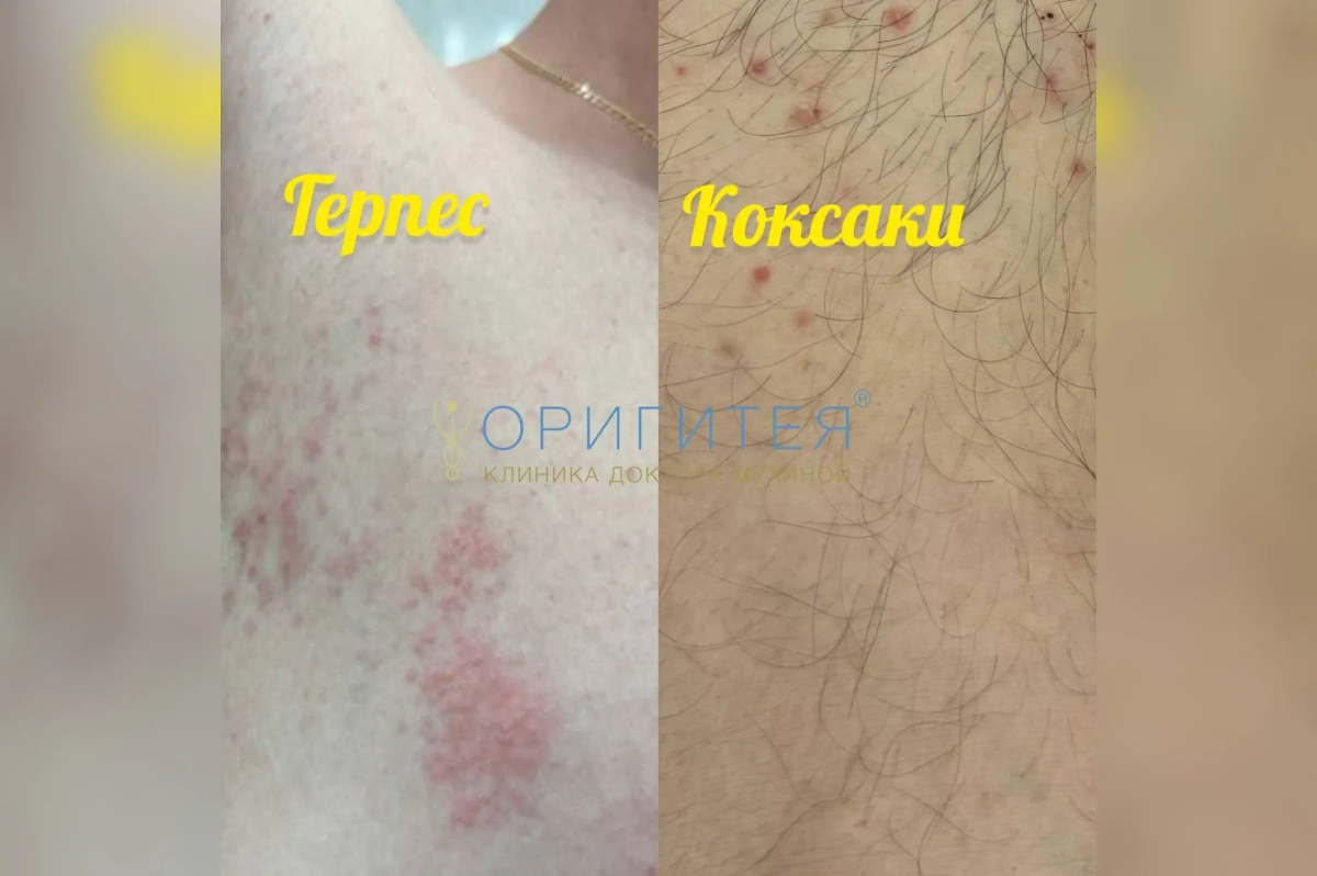Сравнение вирусов герпеса и Коксаки. Фото © Предоставлено Марият Мухиной