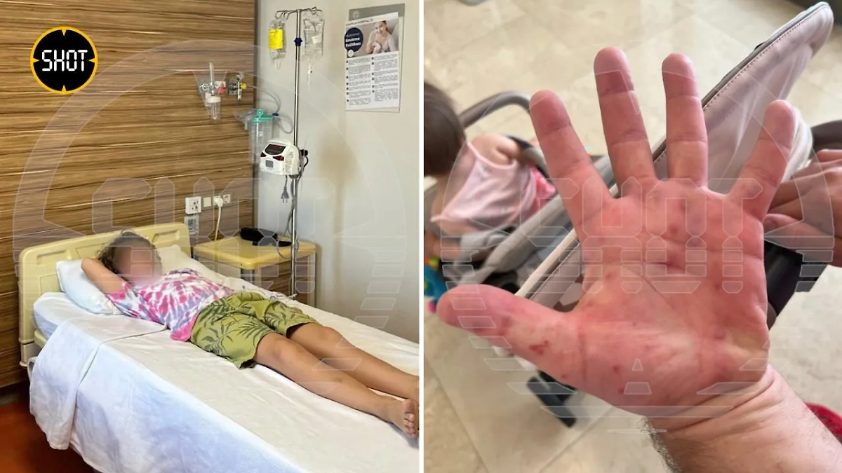 Вспышка Коксаки в Турции. Фото © SHOT