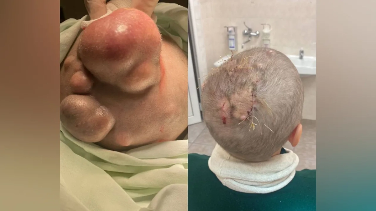 Московские хирурги избавили женщину от десяти опухолей на голове. Фото © Telegram / Московская медицина