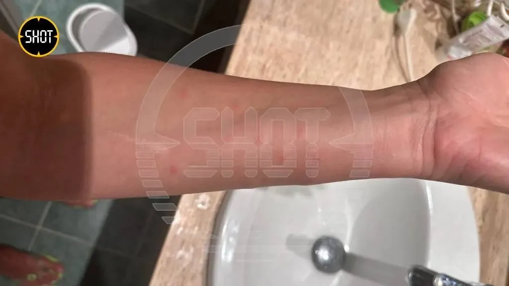 Волдыри после укусов хехенов. Фото © SHOT