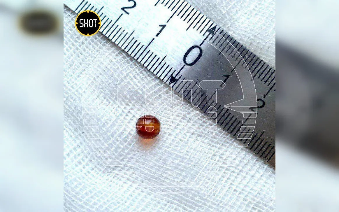 Бусинка, которая 76 лет находилась в ухе пенсионерки. Фото © SHOT