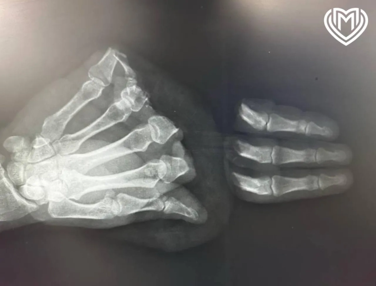 Рентгеновский снимок руки пациента. Фото © Telegram / Московская медицина 