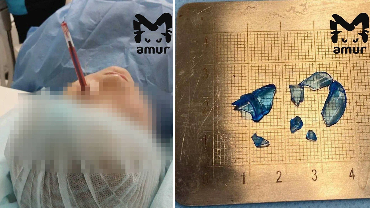 Осколки ручки, которые достали из носа девочки. Фото © Telegram / Amur Mash