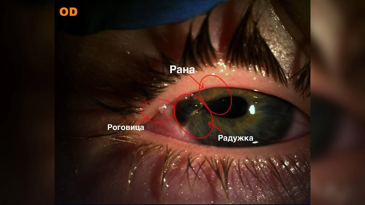 Повреждённый глаз ребёнка. Фото © Пресс-служба Минздрава Подмосковья