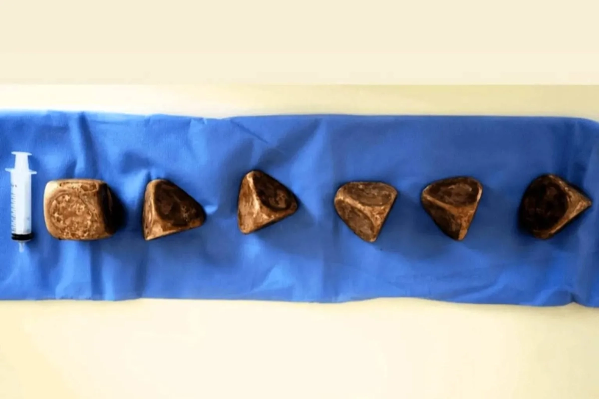 Камни в мочевом пузыре, имеющие форму пирамид. Фото © Jam Press