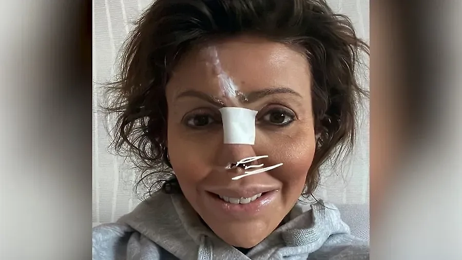 Алиса Казьмина после одной из промежуточных операций. Обложка © Instagram ((соцсеть запрещена в РФ; принадлежит корпорации Meta, которая признана в РФ экстремистской) / agapovdg