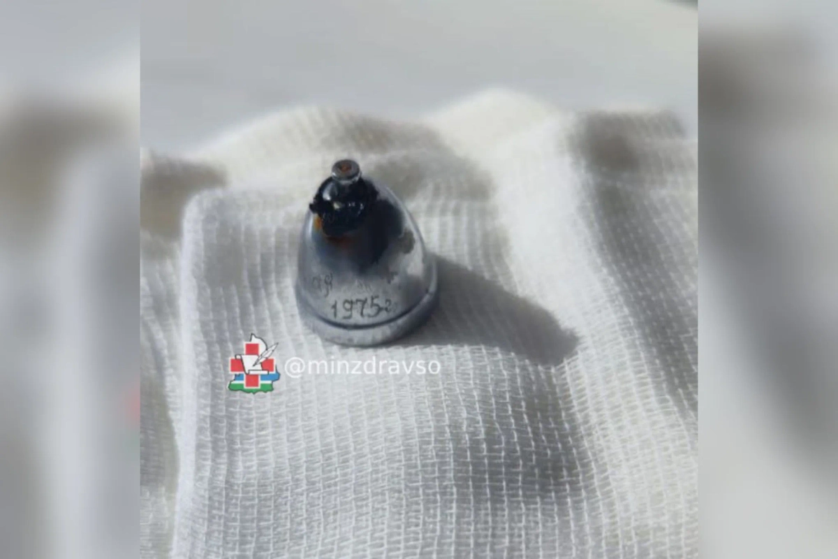 Колокольчик, который врачи достали из уральца. Обложка © Telegram / «Здоровье удальцОв»