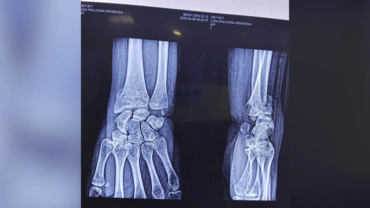 У россиянки перелом руки в трёх местах. Фото © SHOT