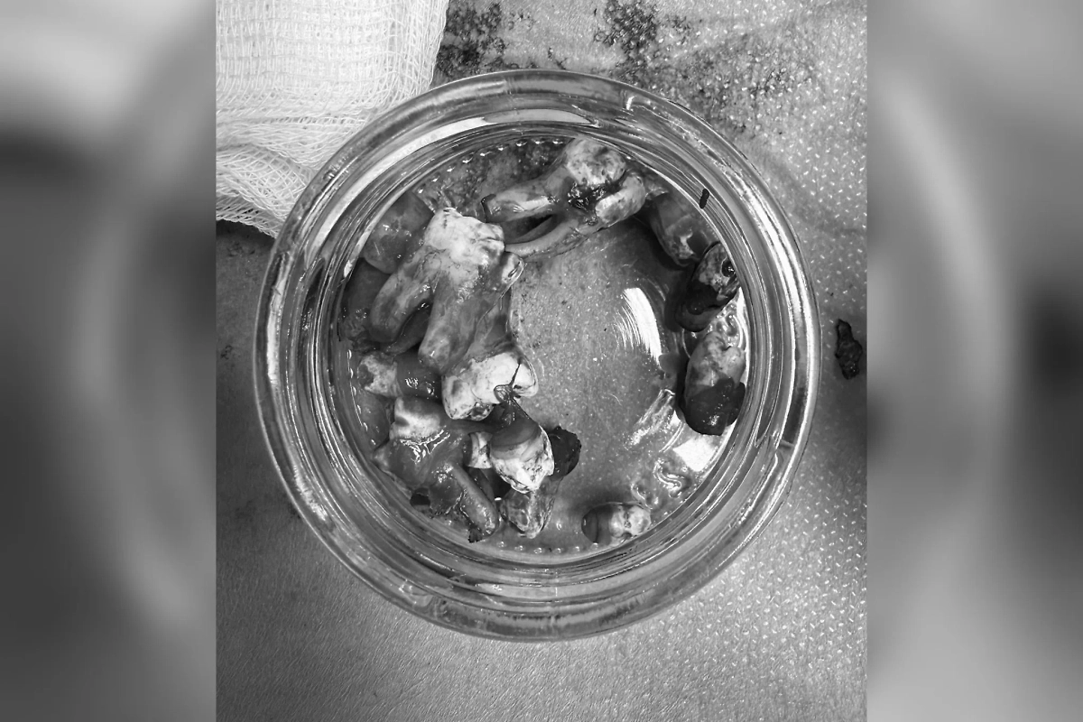 Врачи удалили 14 лишних зубов у подростка. Фото © Telegram / Детский центр им. Рошаля