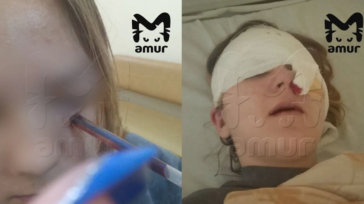 Врачи смогли сохранить зрение девочке после травмы. Фото © Telegram / Amur Mash