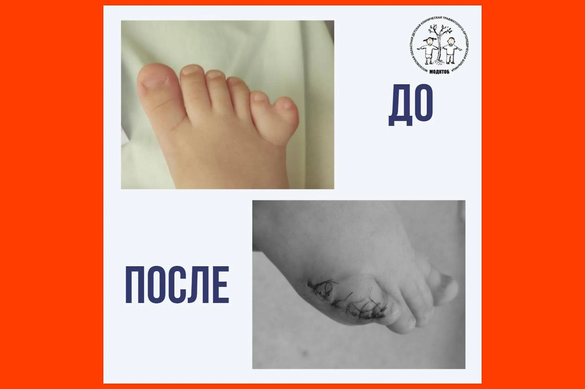 До и после удаления шестого пальца. Фото © Сайт Минздрава РФ