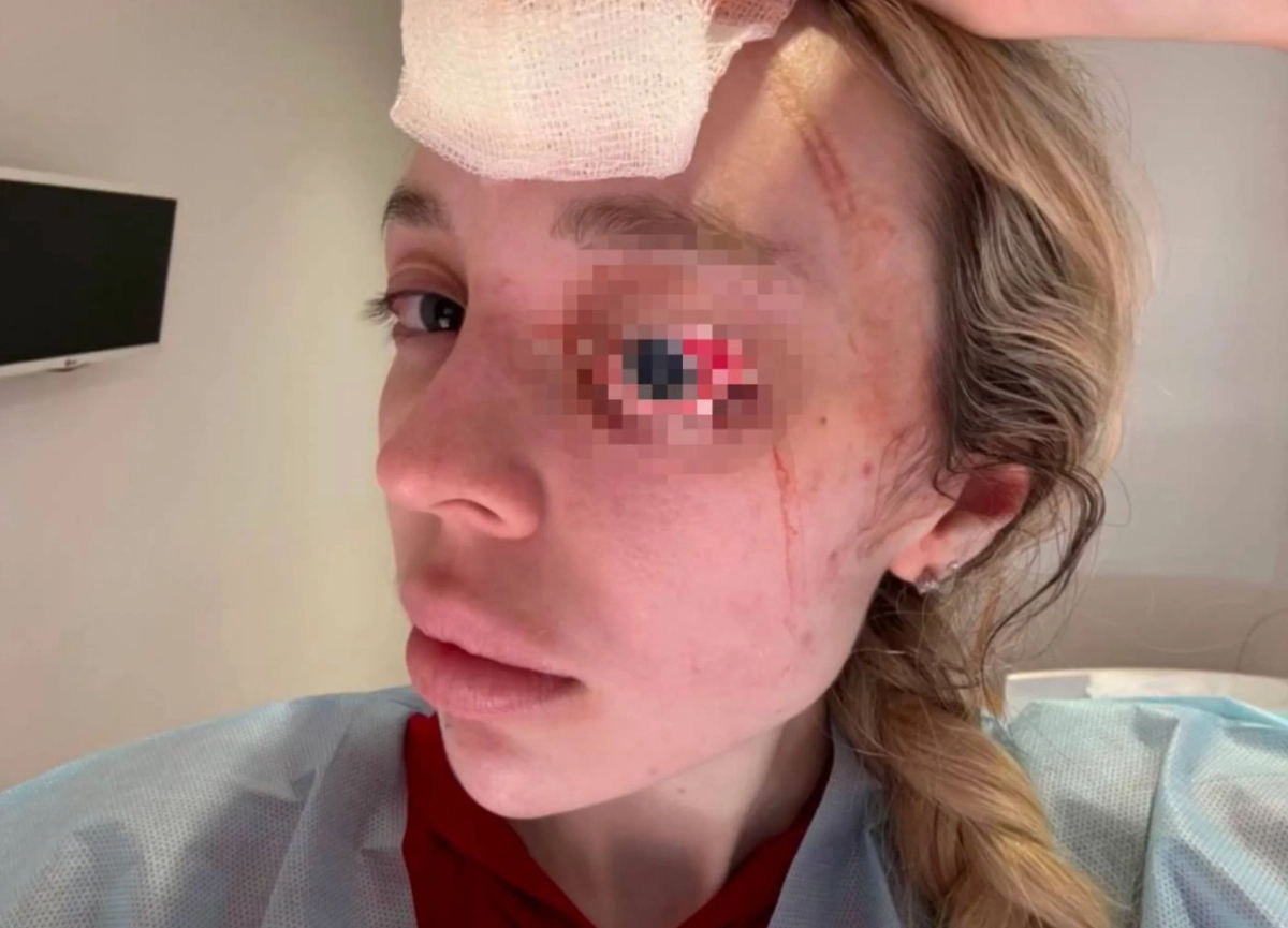 Глаз был сильно повреждён. Фото © Instagram (признан экстремистской организацией и запрещён на территории Российской Федерации) / frosik_frosy