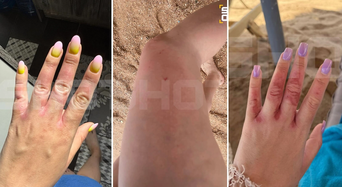 Укусы «безопасных» медуз в Египте. Обложка © SHOT