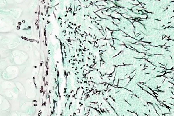 Поражённое аспергиллёзом лёгкое под микроскопом. Фото © Wikipedia / KGH