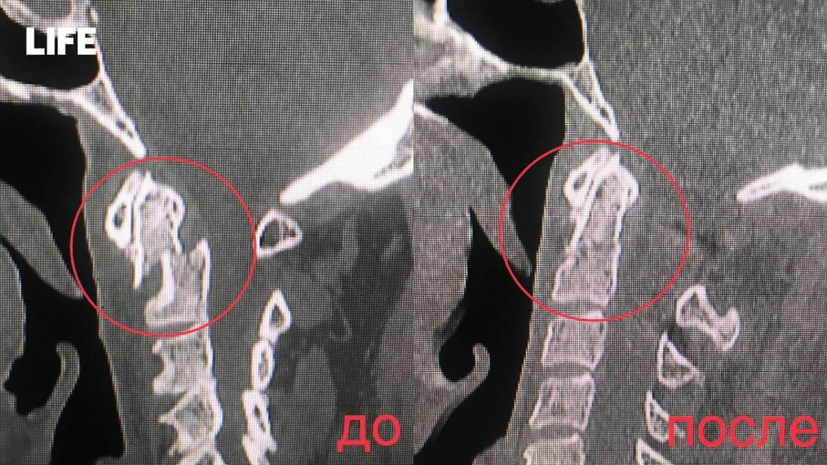 Россиянин подскользнулся дома и получил смертельно опасный «перелом висельника». Фото © Life.ru