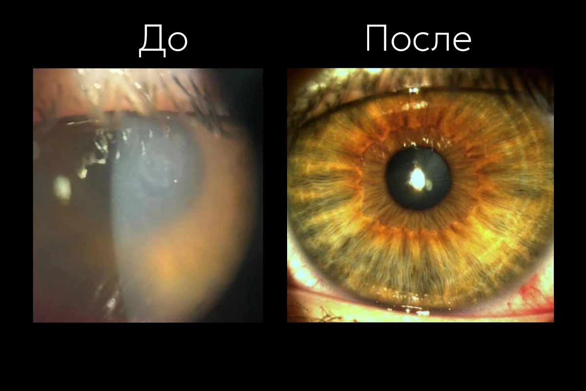 Глаз подростка во время и после трёхмесячного ношения линз. Фото © Минздрав Московской области
