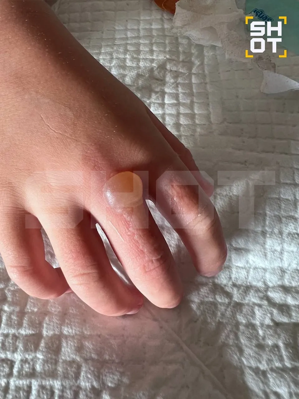 Ядовитые жуки атакуют туристов в отелях Вьетнама и Бали, оставляя жуткие ожоги. Фото © Telegram / SHOT