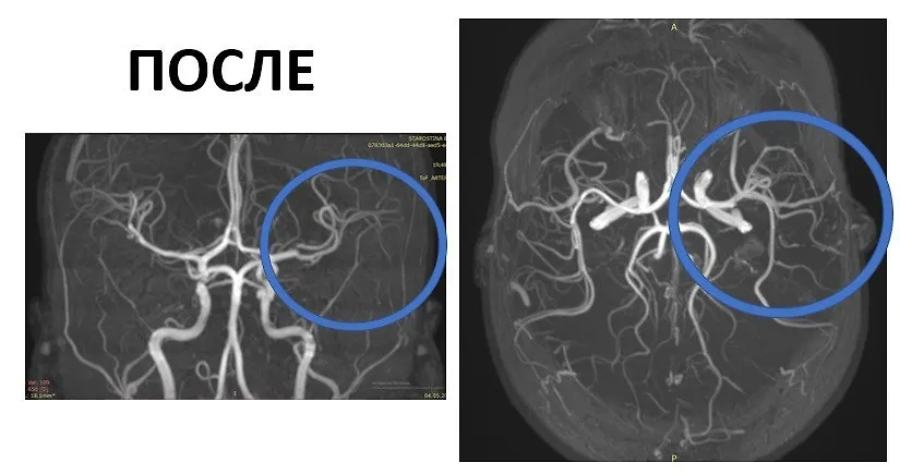 10-летняя девочка перенесла инсульт. Фото © Telegram / Детский центр им. Рошаля