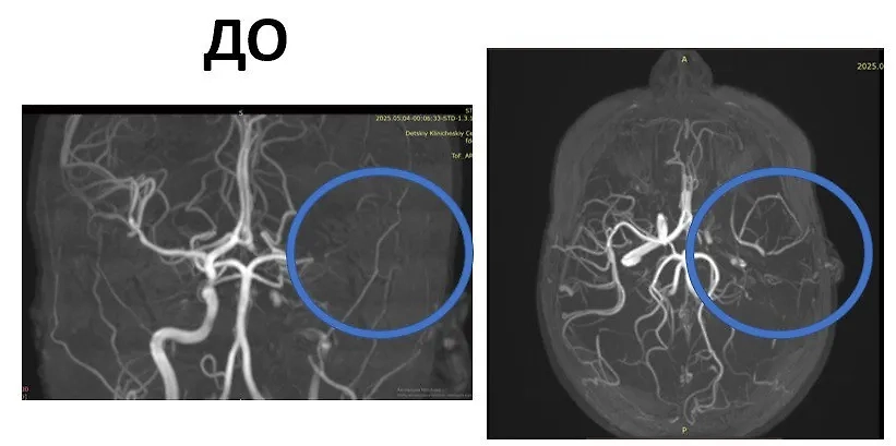 10-летняя девочка перенесла инсульт. Фото © Telegram / Детский центр им. Рошаля