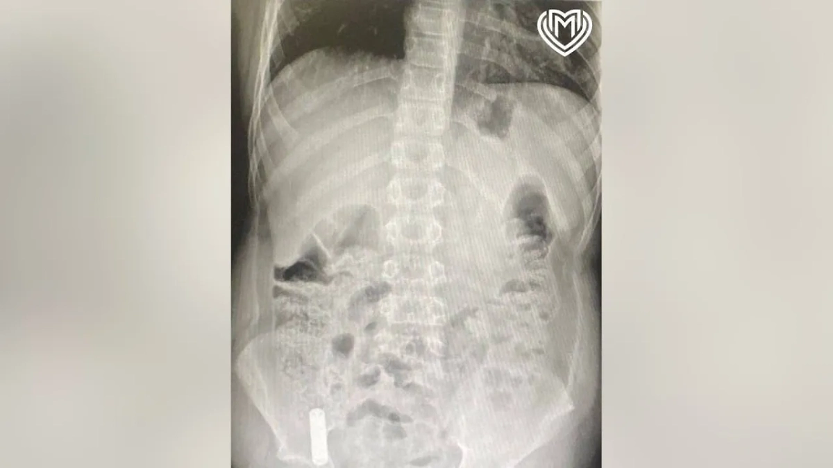 Рентген показал, что батарейка застряла в илеоцекальном углу слепой кишки. Фото © Предоставлено Life.ru