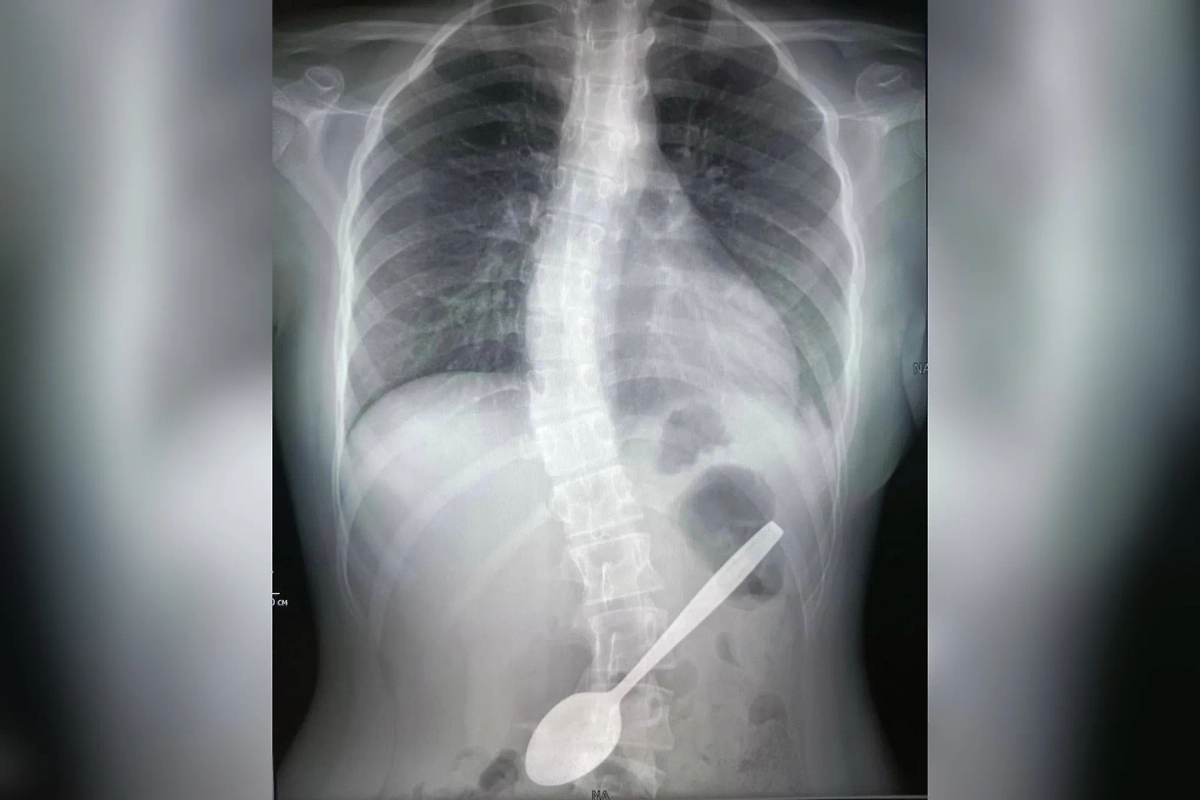 Врачи Центра Рошаля извлекли 15-сантиметровую ложку из желудка девочки. Фото © пресс-служба Министерства здравоохранения Московской области