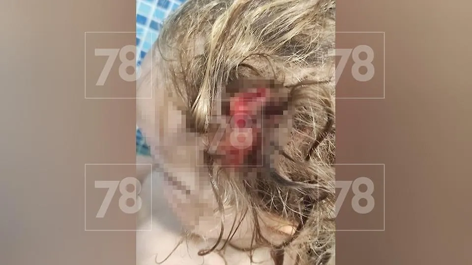 Травма головы у ребёнка. Фото © 78.ru