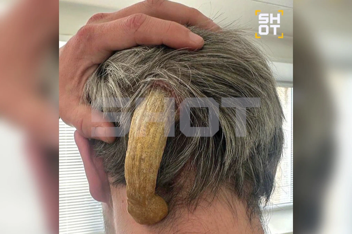 Врачи удалили рог жителю Набережных Челнов. Фото © SHOT