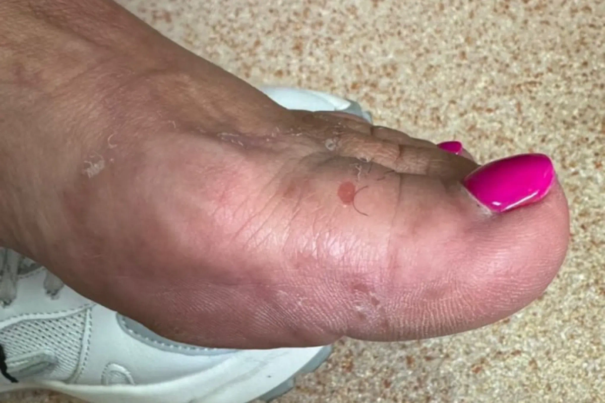 У жительницы Владивостока обнаружили паразита после отдыха в Таиланде. Обложка © Telegram / Владивостокская поликлиника №1