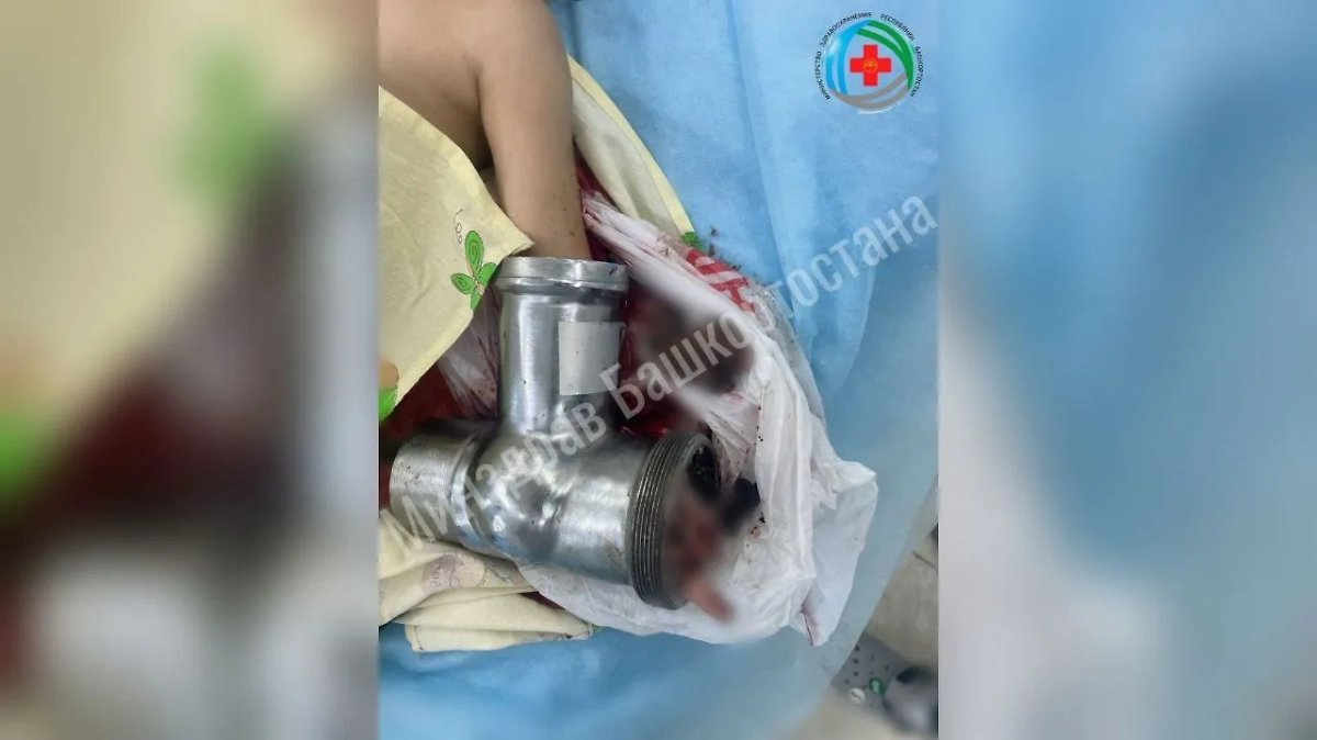 Девочка случайно закрутила палец в мясорубку. Фото © Telegram / Айрат Рахматуллин