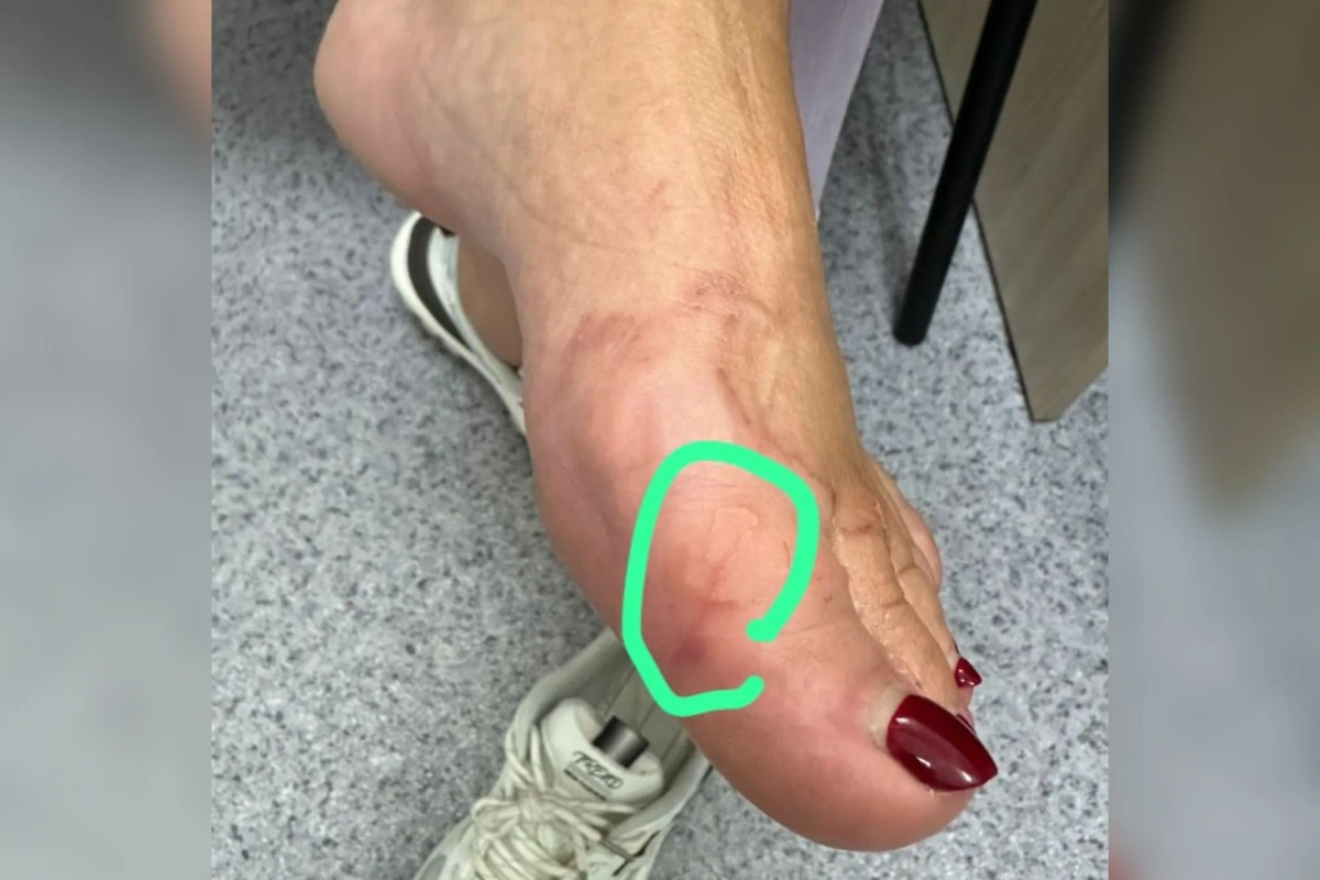 У жительницы Владивостока обнаружили паразита после отдыха в Таиланде. Фото © Telegram / Владивостокская поликлиника №1