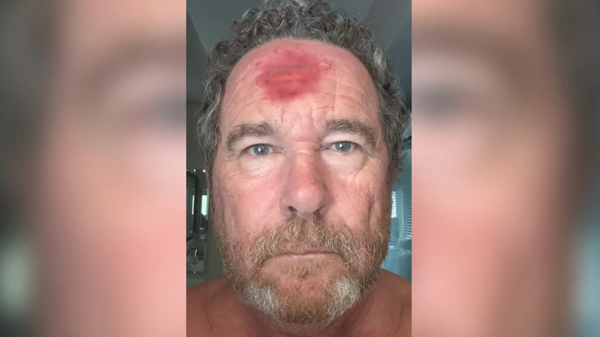 Раненый от резиновой пули фотограф Тоби Кенхэм. Обложка © Instagram (признан экстремистской организацией и запрещён на территории Российской Федерации)/recce_plt/Toby Canham