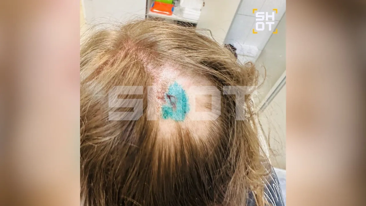 Травма головы. Фото © Telegram / SHOT