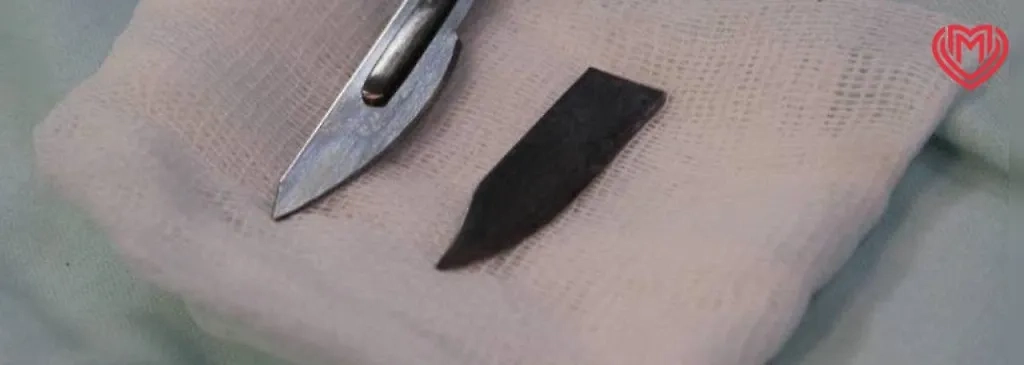 Нож, извлечённый врачами из черепа пациента. Фото © Департамент здравоохранения Москвы