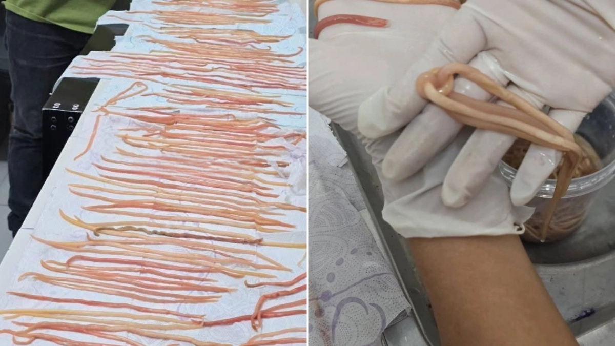 142 червя от 10 до 27 сантиметров, которых извлекли из мальчика в Мексике. Обложка © Х / CUENTAME