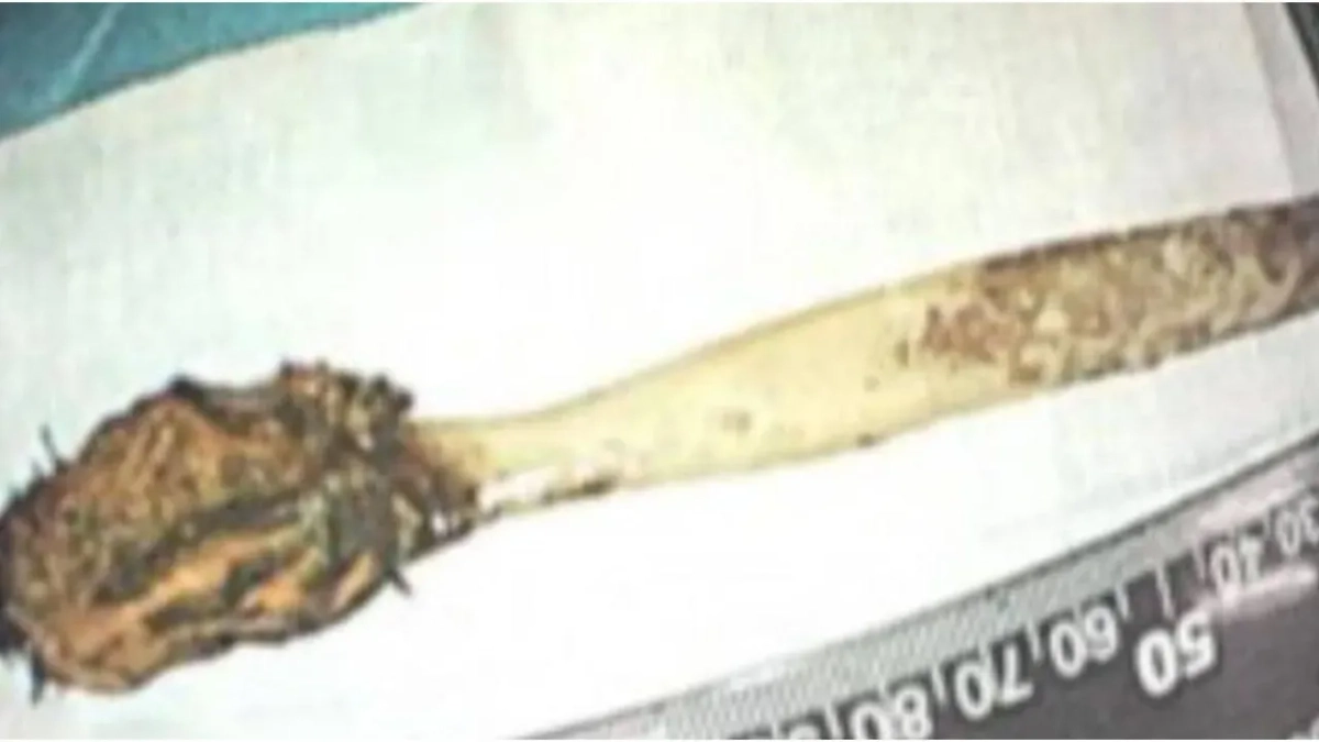 Зубная щетка, которую вытащили из тонкого кишечника мужчины в Китае. Обложка © Х / MustShareNews