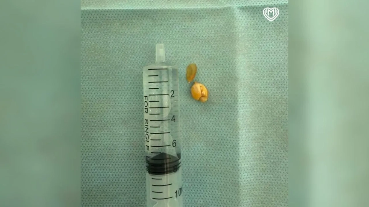 Зёрнышко, которое едва не угробило ребёнка. Фото © Telegram / SHOT