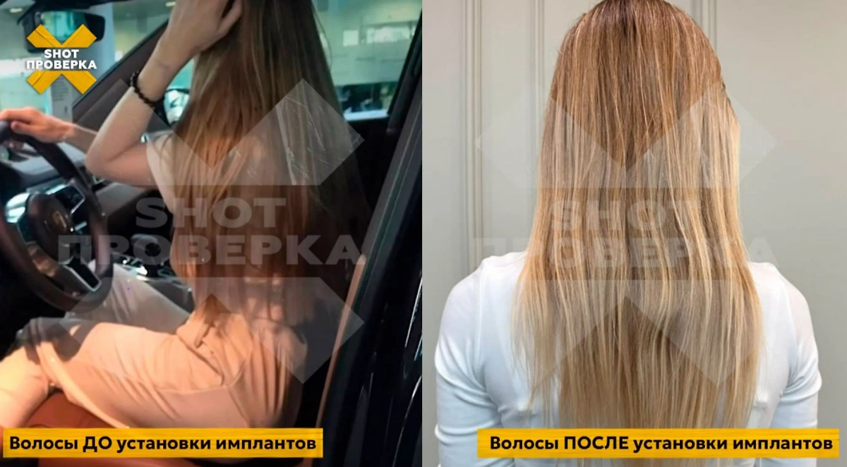 Россиянка посадила здоровье из-за операции по увеличению груди. Фото © SHOT ПРОВЕРКА