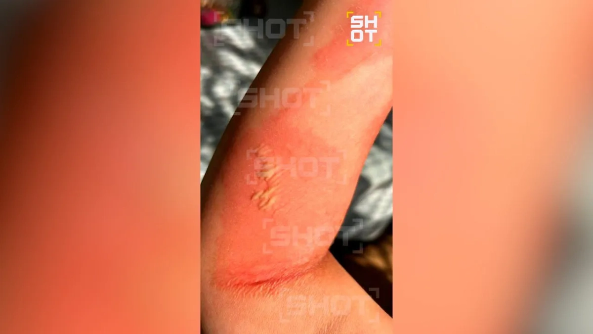 Рука девушки после инцидента. Фото © Telegram / SHOT